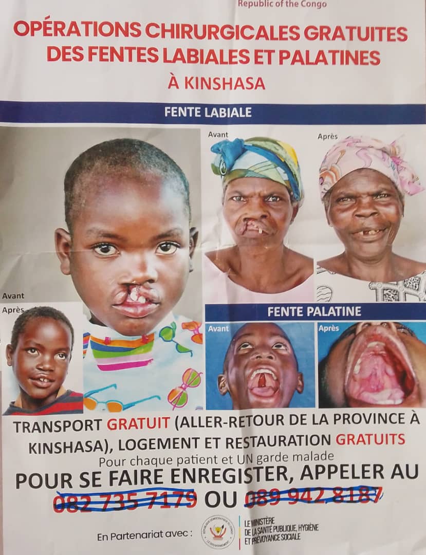 SANTÉ : L’ONG « Opération Smile RDC » lance un appel urgent pour des chirurgies gratuites de la fente labiale